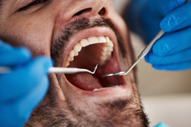 Best Emergency Wisdom Teeth Removal in Queen Anne, MD